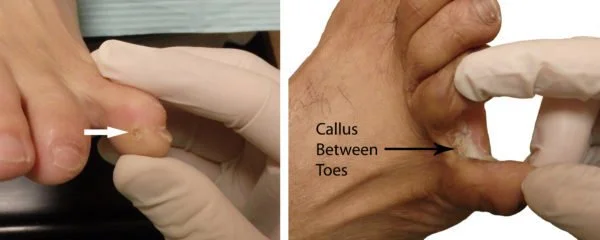 Cure for corns in between toes shop